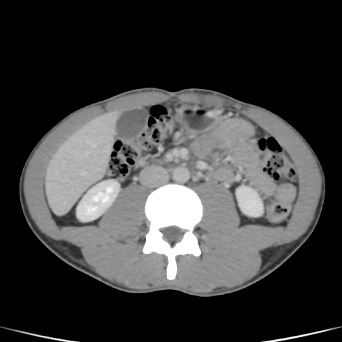 File:Chronic calcific pancreatitis (Radiopaedia 56280-62953 C 34).jpg