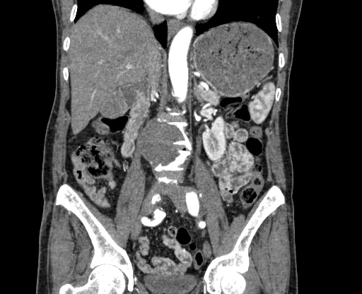 File:Chronic contained rupture of abdominal aortic aneurysm with extensive erosion of the vertebral bodies (Radiopaedia 55450-61901 D 39).jpg