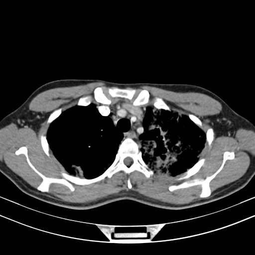 Chronic eosinophilic pneumonia (Radiopaedia 39331-41587 Axial C+ delayed 33).png