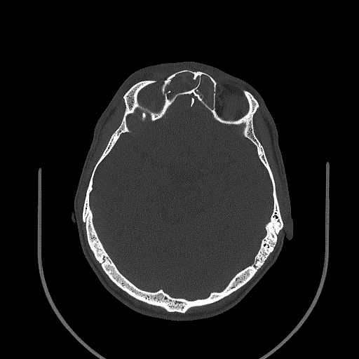 Chronic invasive fungal sinusitis (Radiopaedia 50342-55710 Axial bone window 105).jpg