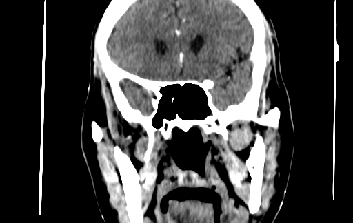 Chronic invasive fungal sinusitis (Radiopaedia 91563-109286 D 85).jpg
