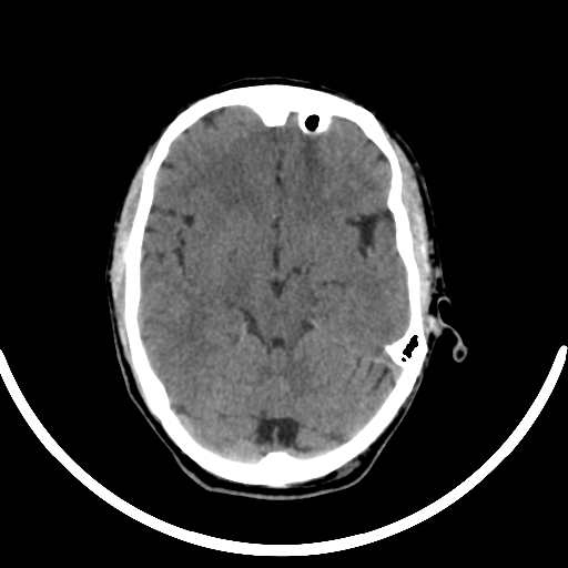 Chronic invasive fungal sinusitis with intraorbital and intracranial extension (Radiopaedia 56387-63046 Axial non-contrast 172).jpg