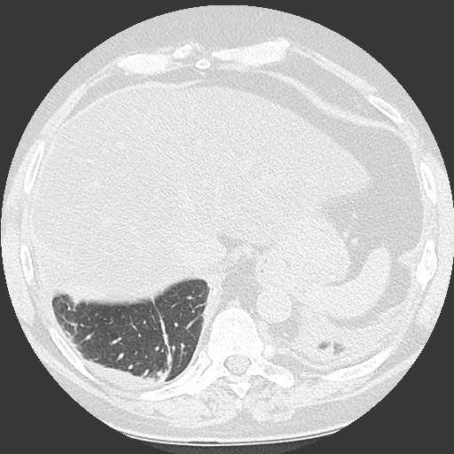 Chronic lung allograft dysfunction - restrictive form (Radiopaedia 60595-68316 Axial lung window 61).jpg