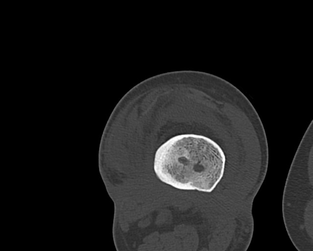 Chronic ostemyelitis of the femur with long sinus tract (Radiopaedia 74947-85982 Axial bone window 175).jpg
