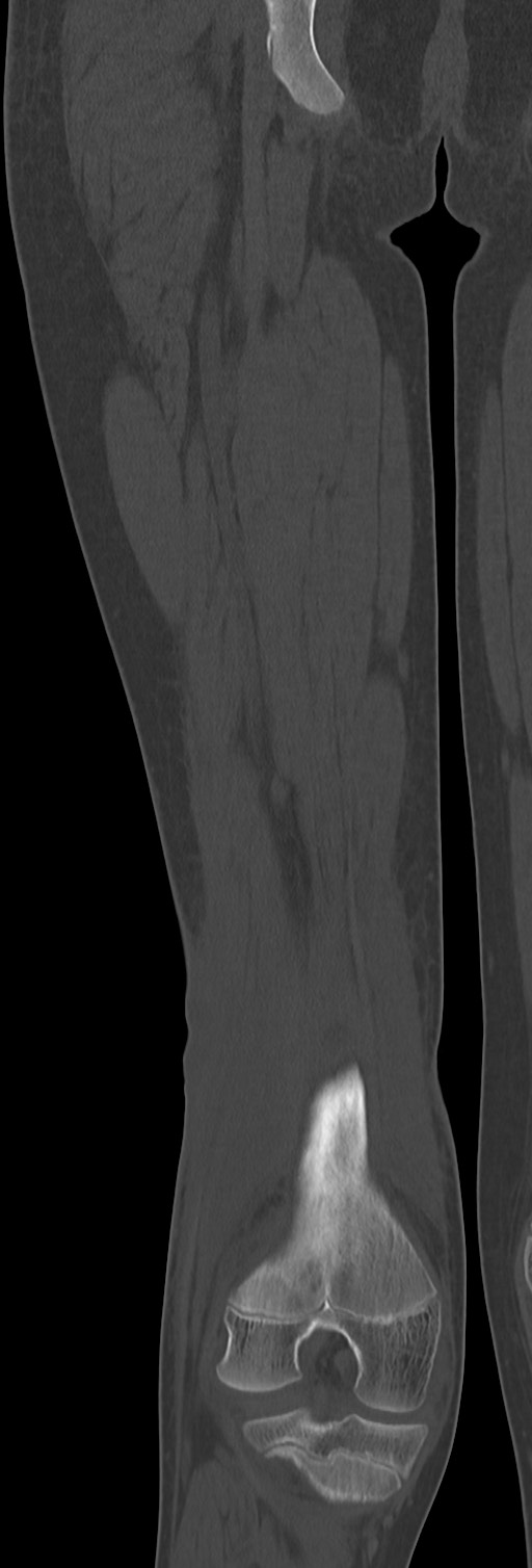 Chronic ostemyelitis of the femur with long sinus tract (Radiopaedia 74947-85982 Coronal bone window 54).jpg