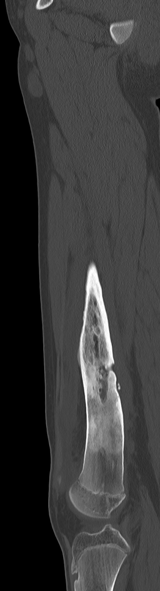 Chronic ostemyelitis of the femur with long sinus tract (Radiopaedia 74947-85982 Sagittal bone window 53).jpg