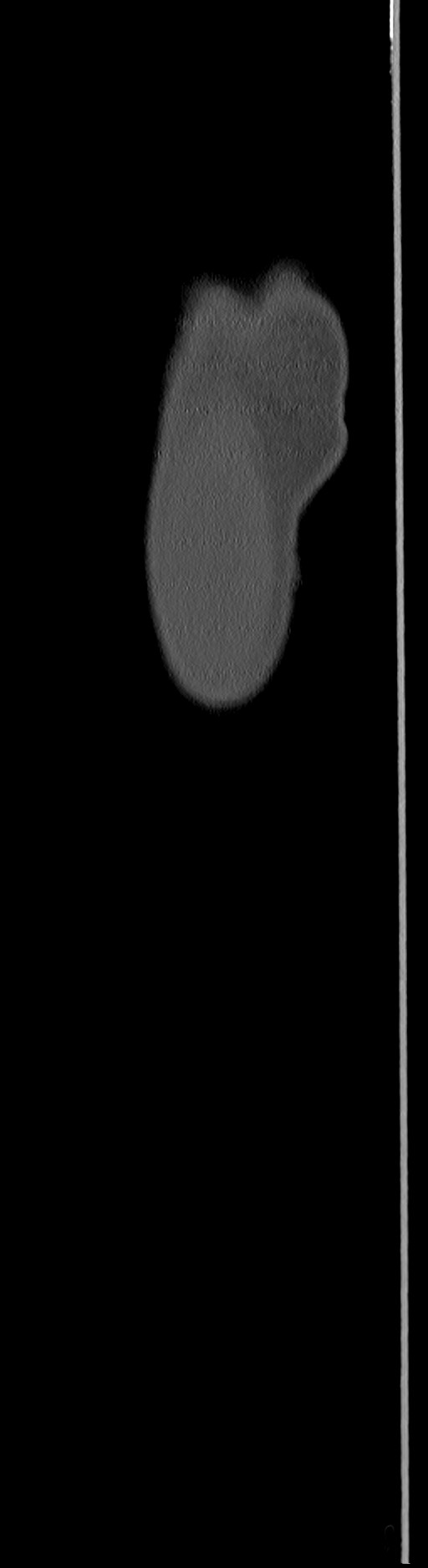 Chronic osteomyelitis (with sequestrum) (Radiopaedia 74813-85822 C 109).jpg