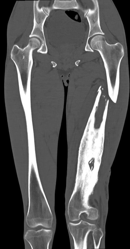 Chronic osteomyelitis (with sequestrum) (Radiopaedia 74813-85822 Coronal non-contrast 30).jpg