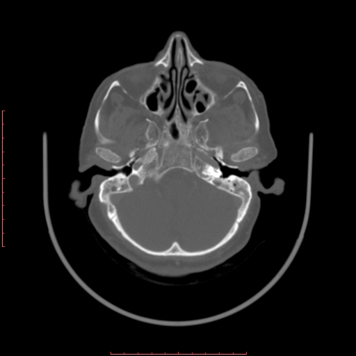 Chronic osteomyelitis - maxilla (Radiopaedia 23783-23927 Axial bone window 119).jpg