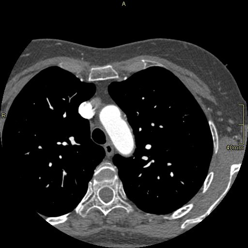 Chronic pulmonary embolism (Radiopaedia 73073-85094 Axial C+ CTPA 18).jpg