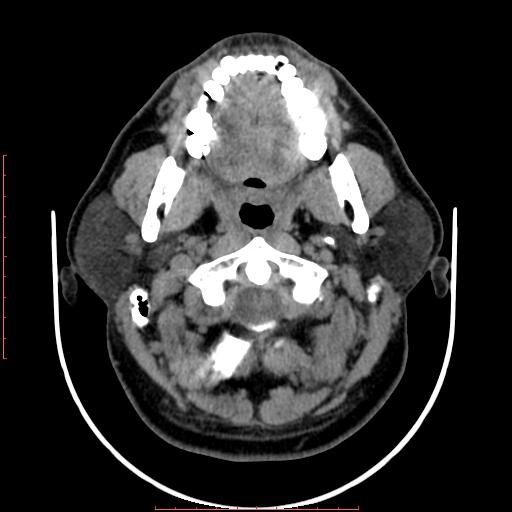 Chronic submandibular sialolithiasis (Radiopaedia 69817-79814 Axial non-contrast 59).jpg