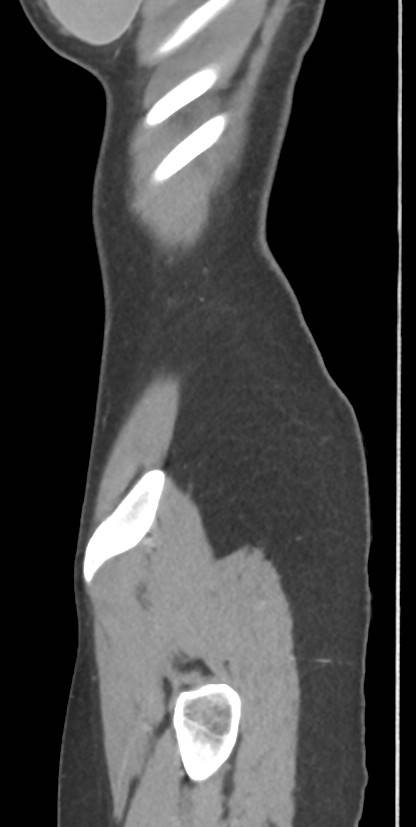 Circumaortic left renal vein with a duplicated retroaortic vein (Radiopaedia 91668-109398 C 121).jpg
