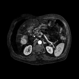 File:Cirrhosis and hepatocellular carcinoma in the setting of hemochromatosis (Radiopaedia 75394-86594 Axial T1 C+ fat sat 122).jpg
