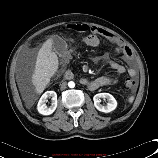File:Cirrhosis and hepatocellular carcinoma in the setting of hemochromatosis (Radiopaedia 75394-86595 A 43).jpg