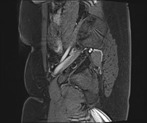 File:Class II Mullerian duct anomaly- unicornuate uterus with rudimentary horn and non-communicating cavity (Radiopaedia 39441-41755 G 10).jpg