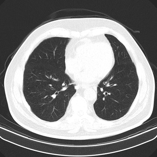 File:Classic complicated silicosis (Radiopaedia 49720-54961 Axial lung window 37).jpg