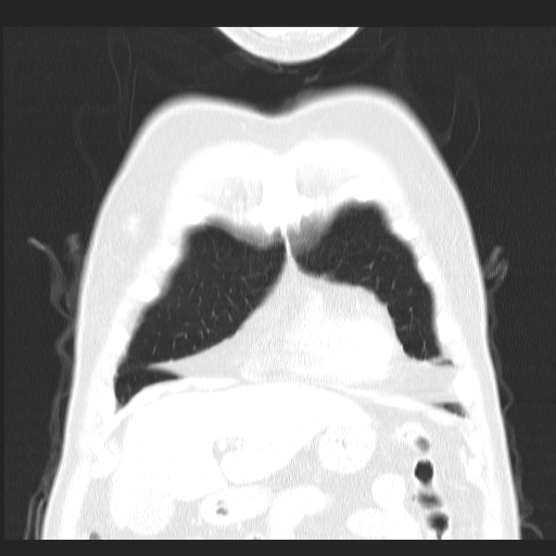 File:Classic complicated silicosis (Radiopaedia 49720-54961 Coronal lung window 6).jpg