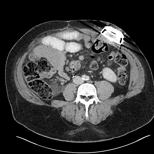 File:Closed loop obstruction - internal hernia into nephrectomy bed (Radiopaedia 59867-67320 Axial 28).jpg