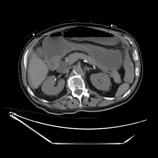 Closed loop obstruction due to adhesive band, resulting in small bowel ischemia and resection (Radiopaedia 83835-99023 Axial non-contrast 54).jpg