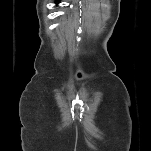 Closed loop obstruction due to adhesive band, resulting in small bowel ischemia and resection (Radiopaedia 83835-99023 C 115).jpg