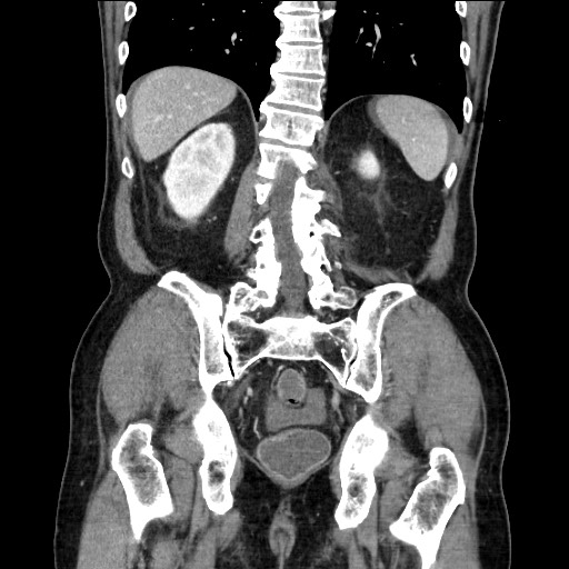 Closed loop obstruction due to adhesive band, resulting in small bowel ischemia and resection (Radiopaedia 83835-99023 E 94).jpg