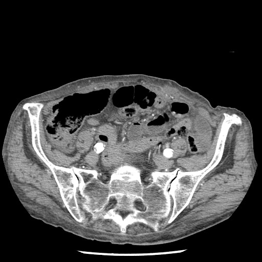 Closed loop small bowel obstruction - adhesions and infarct (Radiopaedia 85125-100678 A 137).jpg