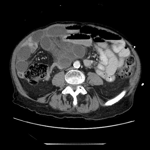 Closed loop small bowel obstruction - adhesive disease and hemorrhagic ischemia (Radiopaedia 86831-102990 A 112).jpg
