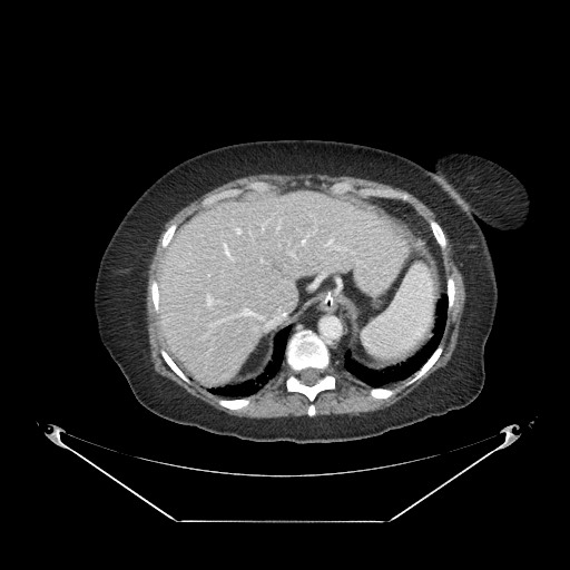 Closed loop small bowel obstruction - internal hernia (Radiopaedia 65402-74450 A 16).jpg
