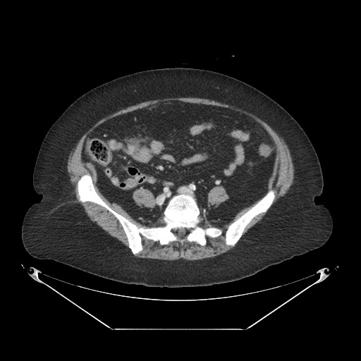 Closed loop small bowel obstruction - internal hernia (Radiopaedia 65402-74450 A 88).jpg