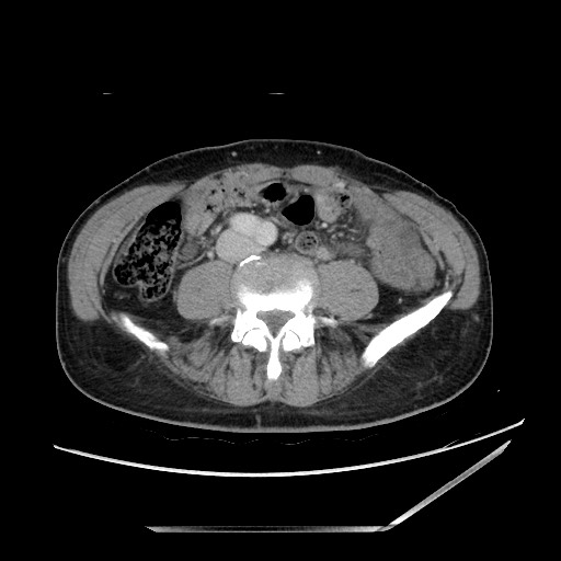 Closed loop small bowel obstruction - omental adhesion causing "internal hernia" (Radiopaedia 85129-100682 A 103).jpg
