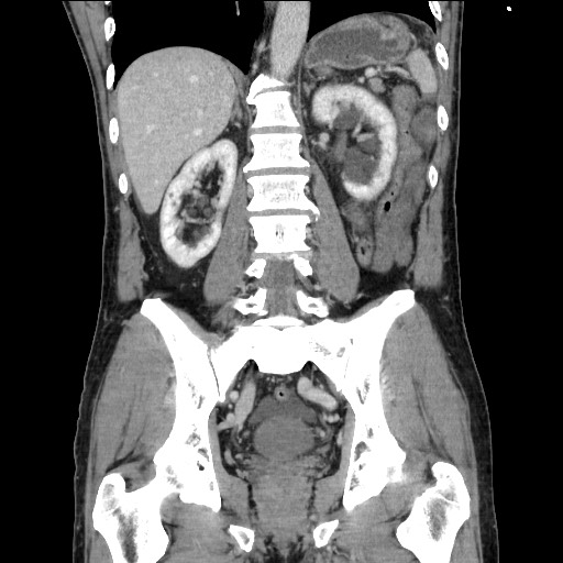 Closed loop small bowel obstruction - omental adhesion causing "internal hernia" (Radiopaedia 85129-100682 B 84).jpg