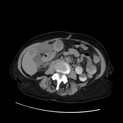 Closed loop small bowel obstruction due to adhesive band, with intramural hemorrhage and ischemia (Radiopaedia 83831-99017 Axial non-contrast 84).jpg