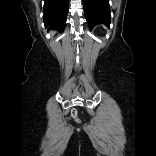 File:Closed loop small bowel obstruction due to adhesive bands - early and late images (Radiopaedia 83830-99015 B 107).jpg