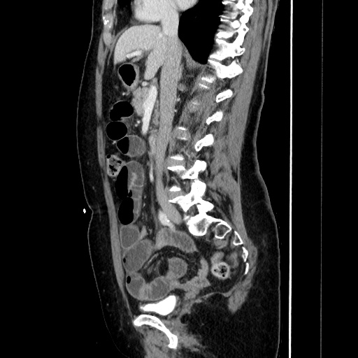 Closed loop small bowel obstruction due to adhesive bands - early and late images (Radiopaedia 83830-99015 C 82).jpg