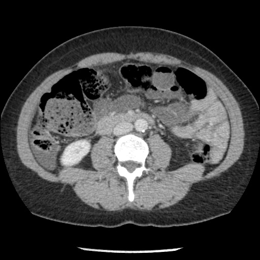Closed loop small bowel obstruction due to trans-omental herniation (Radiopaedia 35593-37109 A 46).jpg