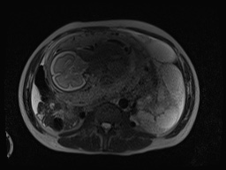 Closed loop small bowel obstruction in pregnancy (MRI) (Radiopaedia 87637-104031 D 1).jpg