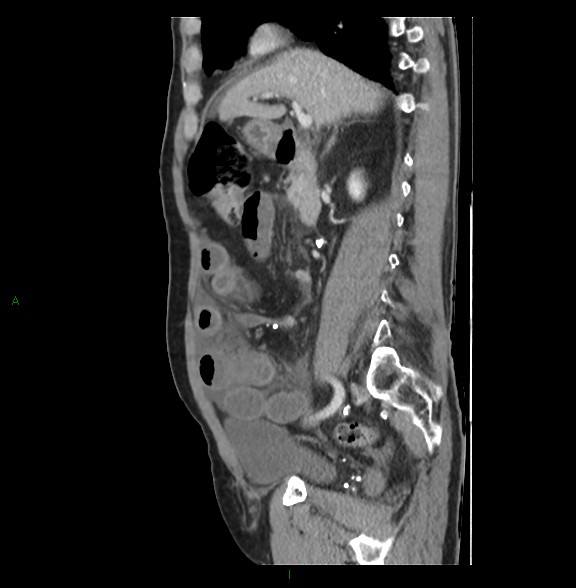 File:Closed loop small bowel obstruction with ischemia (Radiopaedia 84180-99456 C 37).jpg