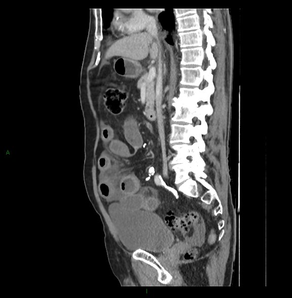File:Closed loop small bowel obstruction with ischemia (Radiopaedia 84180-99456 C 43).jpg