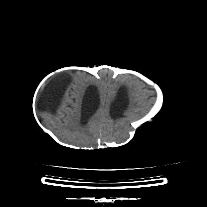 Cloverleaf skull (Radiopaedia 91901-109710 Axial non-contrast 114).jpg