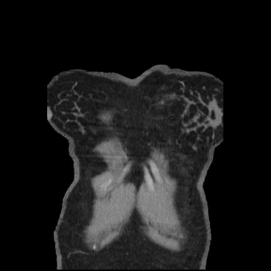 Coarctation of the aorta (Radiopaedia 67609-77010 B 64).jpg