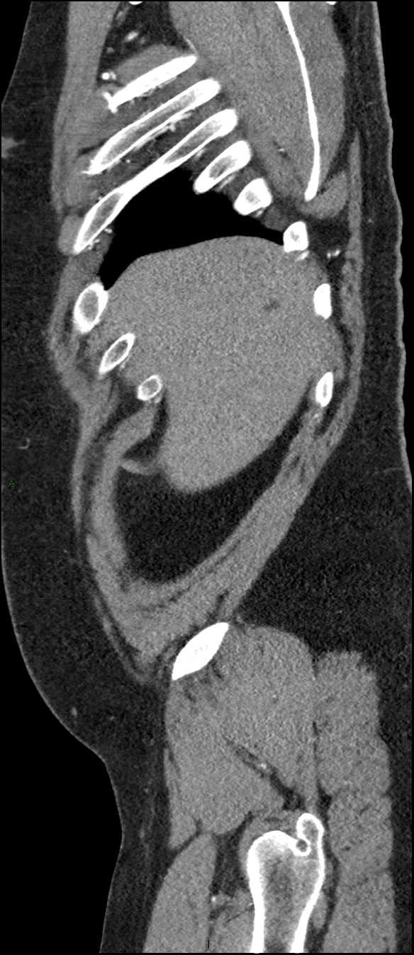 Coarctation of the aorta (Radiopaedia 74632-88521 C 29).jpg