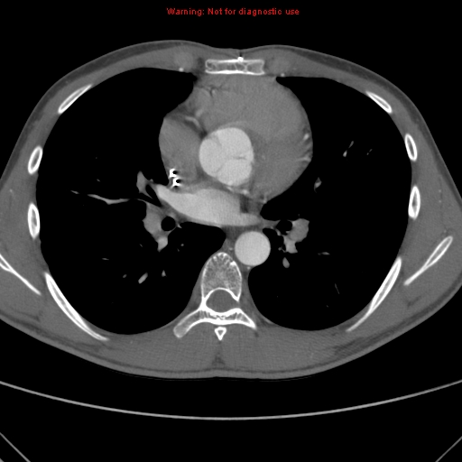 File:Coarctation of the aorta (Radiopaedia 9434-10118 A 99).jpg