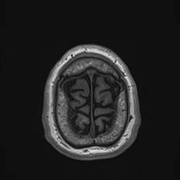Cochlear incomplete partition type III associated with hypothalamic hamartoma (Radiopaedia 88756-105498 Axial T1 177).jpg