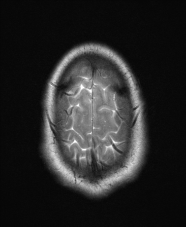 File:Colloid cyst (Radiopaedia 44510-48181 Axial T2 26).png