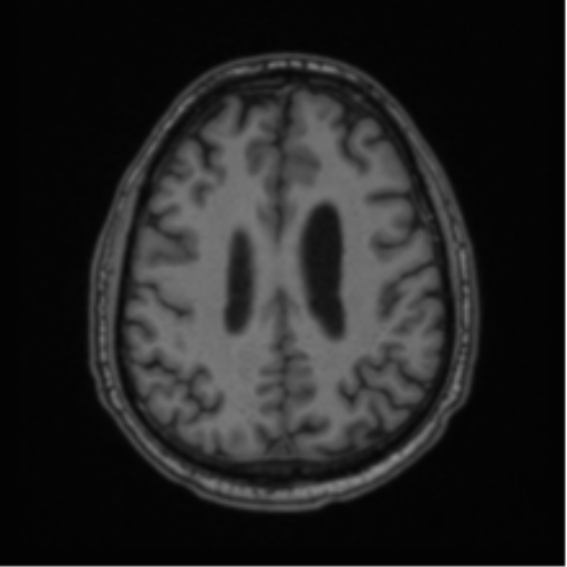 File:Colloid cyst of the third ventricle (Radiopaedia 86571-102662 Axial T1 56).png