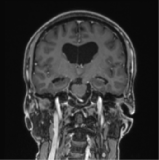 File:Colloid cyst of the third ventricle (Radiopaedia 86571-102662 Coronal T1 C+ 50).png