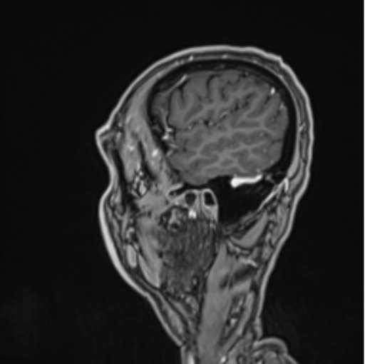 File:Colloid cyst of the third ventricle (Radiopaedia 86571-102662 Sagittal T1 C+ 12).png