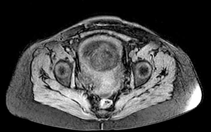 File:Colon adenocarcinoma with Krukenberg tumors, advanced pregnancy (Radiopaedia 67279-76645 A 15).jpg
