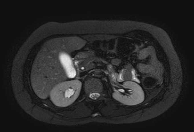 Colon adenocarcinoma with Krukenberg tumors, advanced pregnancy (Radiopaedia 67279-76645 Axial T2 SPAIR 57).jpg