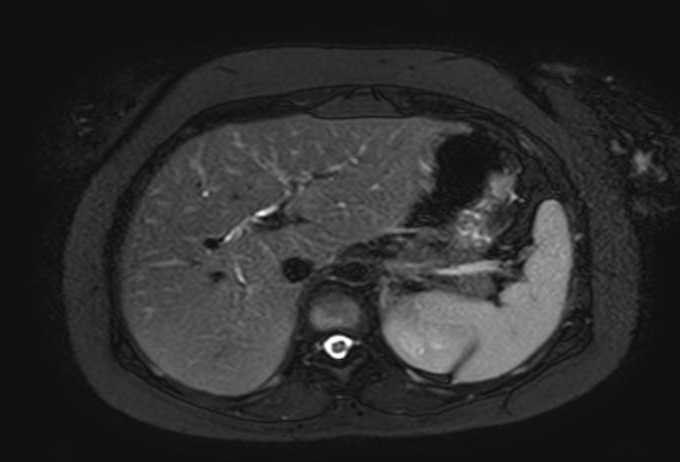 Colon adenocarcinoma with Krukenberg tumors, advanced pregnancy (Radiopaedia 67279-76645 Axial T2 SPAIR 67).jpg
